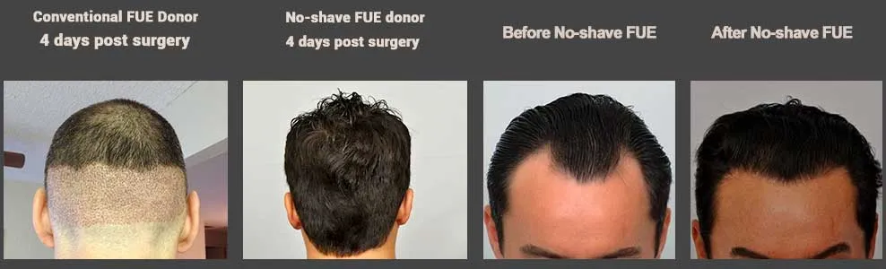 No-Shave FUE Hair Transplant (C2G) | No-shave CIT® | Forhair
