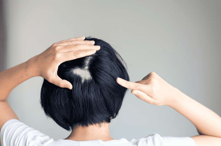 Can Ozempic Cause Hair Loss? - Discover the Facts
