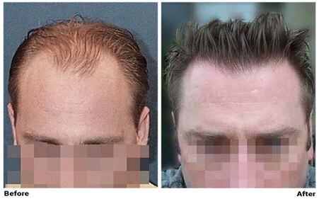 1/6 Joe ヘッド with Hair Implantation New York City Hair Transplant Clinic | Dr. Cole | Forhair