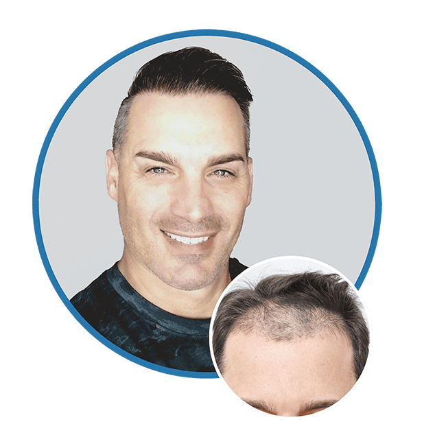 Hair Restoration Results Slider 1