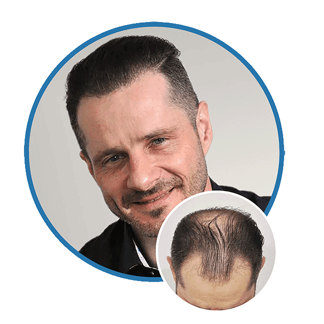 Hair Restoration Results Slider 2